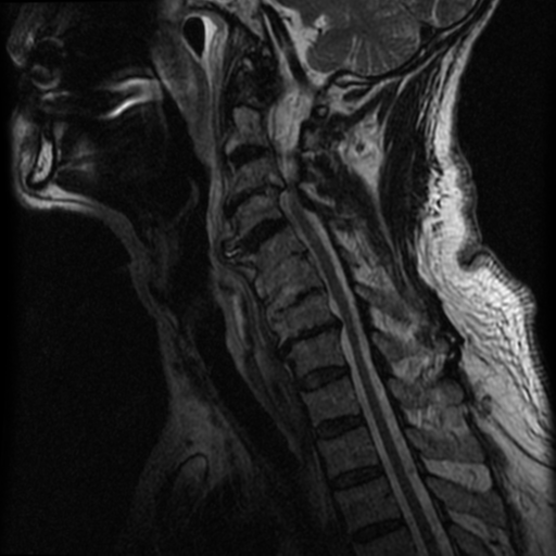 File:Cervical canal stenosis with cord compression (Radiopaedia 34114-35374 Sagittal T2 6).png