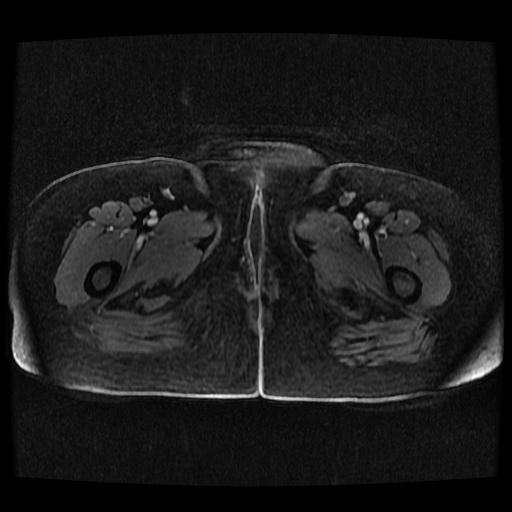 Cervical carcinoma (Radiopaedia 70924-81132 Axial T1 C+ fat sat 188).jpg