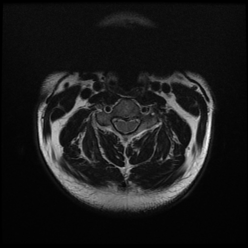 File:Cervical disc extrusion (Radiopaedia 59074-66364 Axial T2 4).jpg