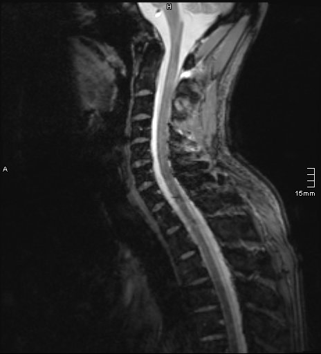 File:Cervical dural CSF leak on MRI and CT treated by blood patch (Radiopaedia 49748-54995 D 6).png