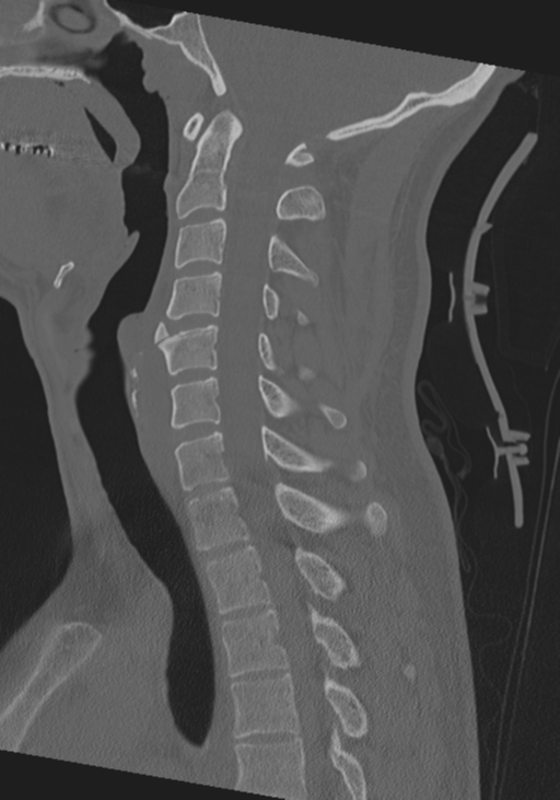 Cervical intercalary bone (Radiopaedia 35211-36748 Sagittal bone window 41).png