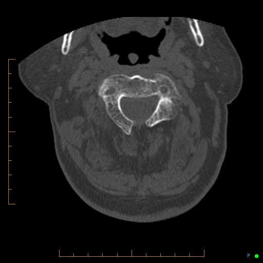 Cervical spine fracture - ankylosing spondylitis (Radiopaedia 76835-88706 Axial bone window 58).jpg