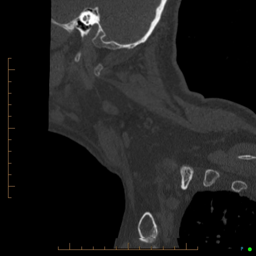 Cervical spine fracture - ankylosing spondylitis (Radiopaedia 76835-88706 Sagittal bone window 101).jpg