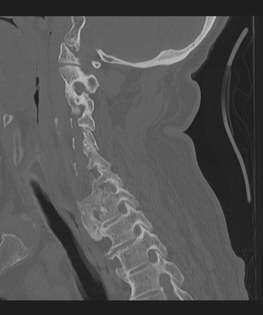 Cervical spine fracture in the setting of ankylosis (Radiopaedia 37038-38715 Sagittal bone window 49).png