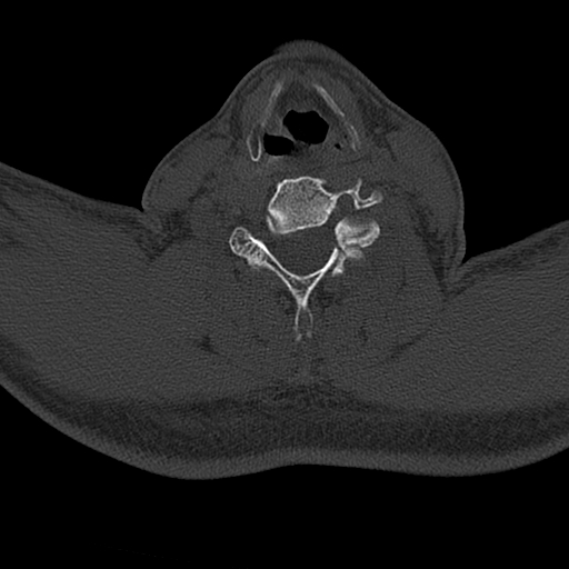 Cervical spine trauma with tear drop fracture and perched facet joint (Radiopaedia 53989-60127 Axial bone window 115).jpg