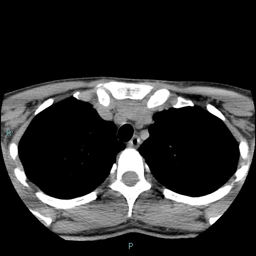 File:Cervical thymic cyst (Radiopaedia 88632-105335 Axial non-contrast 12).jpg