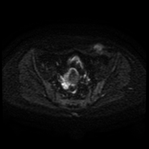 File:Cesarian section scar endometriosis (Radiopaedia 66520-75799 Axial DWI 58).jpg