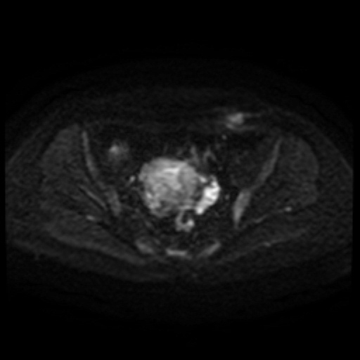 Cesarian section scar endometriosis (Radiopaedia 66520-75799 Axial DWI 85).jpg