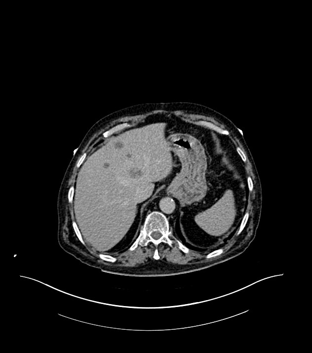 Cholangiocarcinoma with cerebral metastases (Radiopaedia 83519-98629 Axial C+ delayed 18).jpg