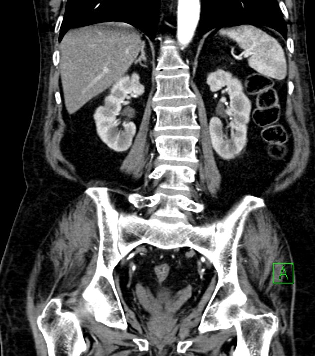 Cholangiocarcinoma with cerebral metastases (Radiopaedia 83519-98629 E 59).jpg