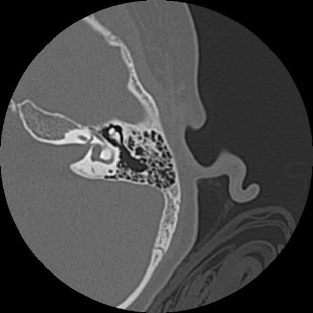 Cholesteatoma (Radiopaedia 73023-83750 Axial Left ear 47).jpg