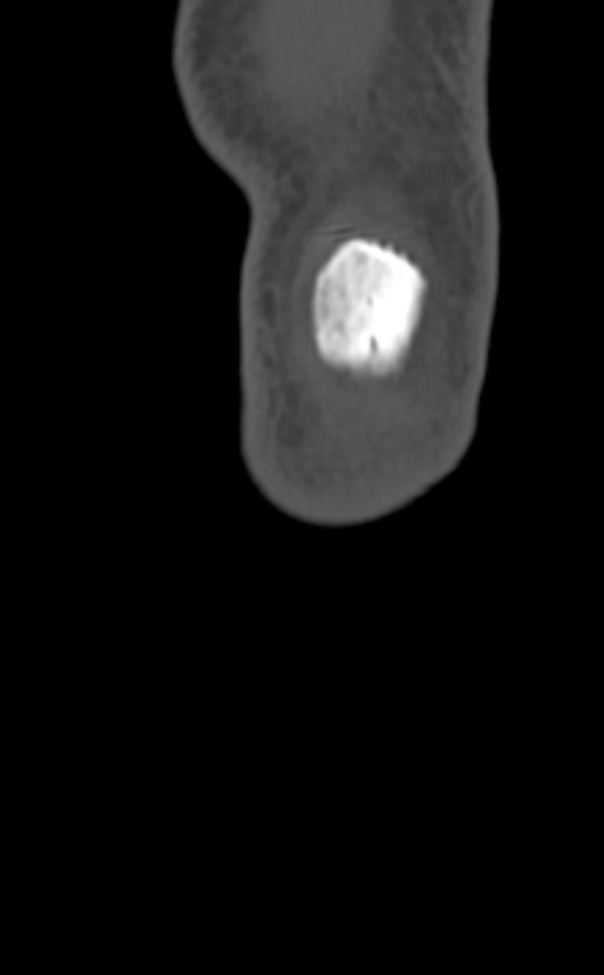 Chondrocalcinosis (Radiopaedia 82862-97173 Coronal bone window 2).jpg
