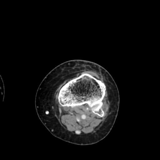 Chondrosarcoma - femur (Radiopaedia 64187-72954 Axial with contrast 69).jpg