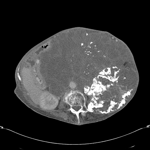Chondrosarcoma of the spine (Radiopaedia 49871-55143 A 30).jpg