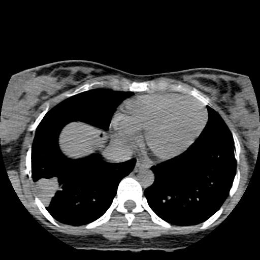File:Choriocarcinoma of ovary with cerebral and pulmonary metastases (Radiopaedia 25983-26119 Axial non-contrast 16).jpg