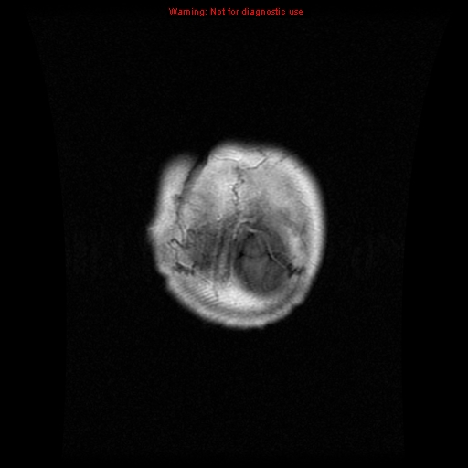File:Choroid plexus carcinoma - recurrent (Radiopaedia 8330-9169 Coronal T1 C+ 23).jpg
