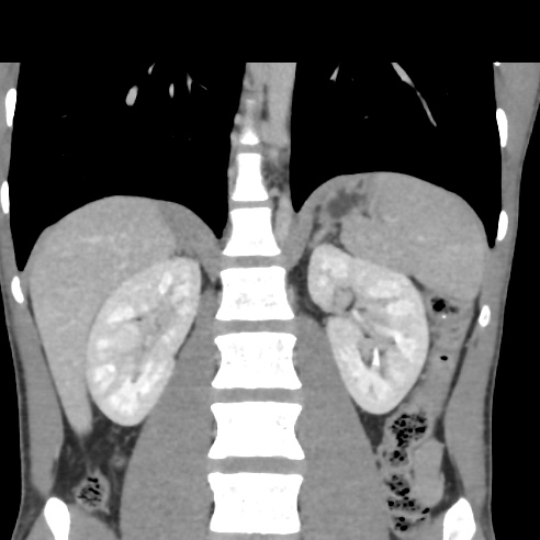 File:Chronic calcific pancreatitis (Radiopaedia 56280-62953 F 20).jpg