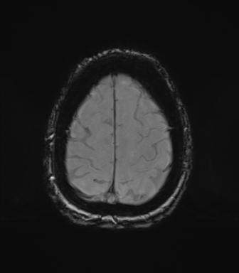 Chronic hypertensive encephalopathy (Radiopaedia 72844-83495 Axial SWI magnitude 73).png