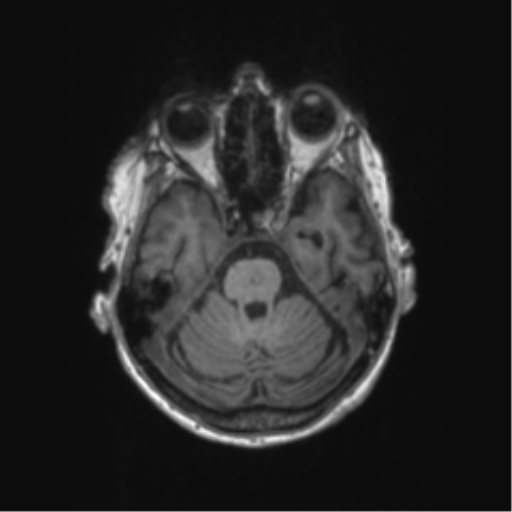 Chronic hypertensive encephalopathy (Radiopaedia 72844-83495 Axial T1 51).png