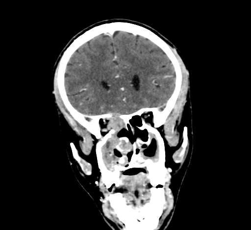 Chronic invasive fungal sinusitis with intraorbital and intracranial extension (Radiopaedia 56387-63046 C 129).jpg