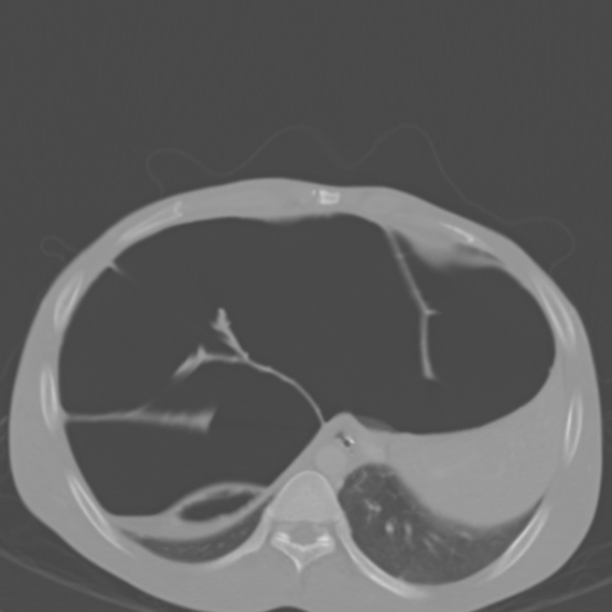 Chronic large bowel pseudo-obstruction (Radiopaedia 43181-46492 Axial bone window 37).jpg