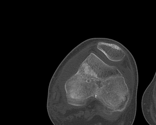 Chronic ostemyelitis of the femur with long sinus tract (Radiopaedia 74947-85982 Axial bone window 214).jpg