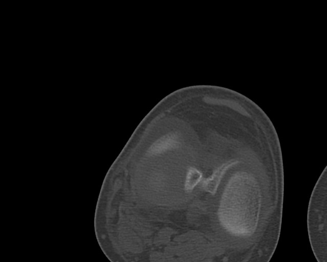 Chronic ostemyelitis of the femur with long sinus tract (Radiopaedia 74947-85982 Axial bone window 229).jpg