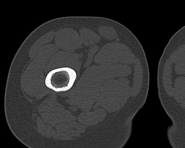 Chronic ostemyelitis of the femur with long sinus tract (Radiopaedia 74947-85982 Axial bone window 40).jpg