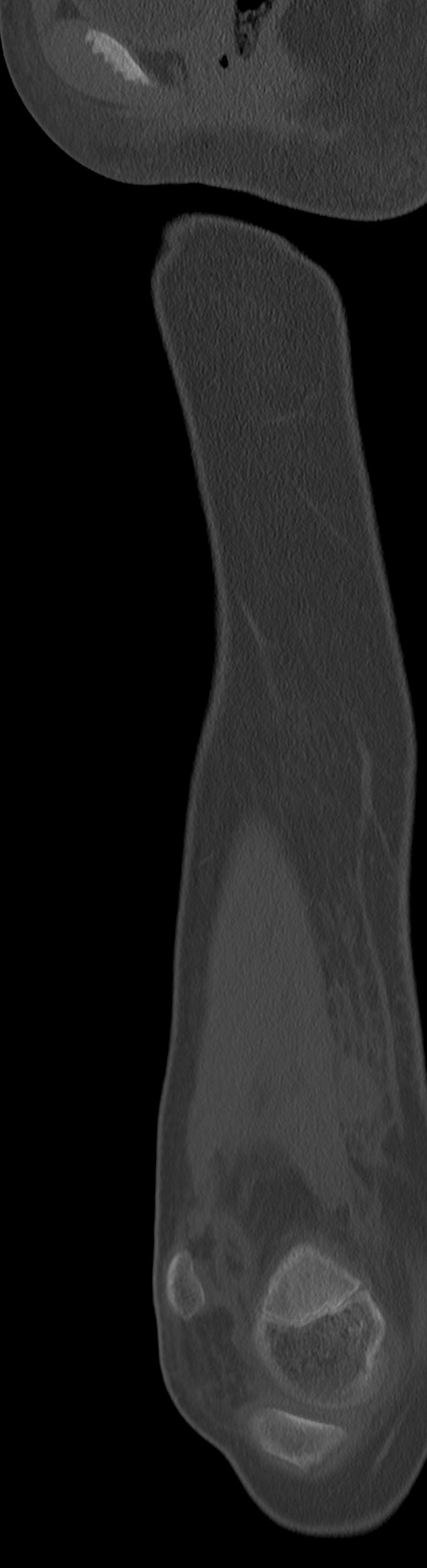 Chronic ostemyelitis of the femur with long sinus tract (Radiopaedia 74947-85982 Sagittal bone window 69).jpg