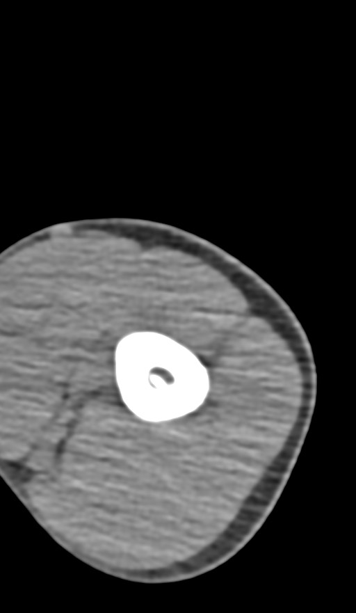 Chronic osteomyelitis of the distal humerus (Radiopaedia 78351-90971 Axial non-contrast 41).jpg