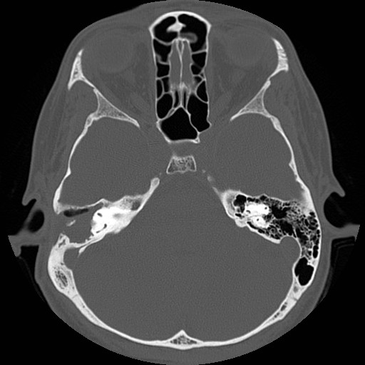 File:Chronic otomastoiditis (Radiopaedia 27138-27309 Axial bone window 41).jpg