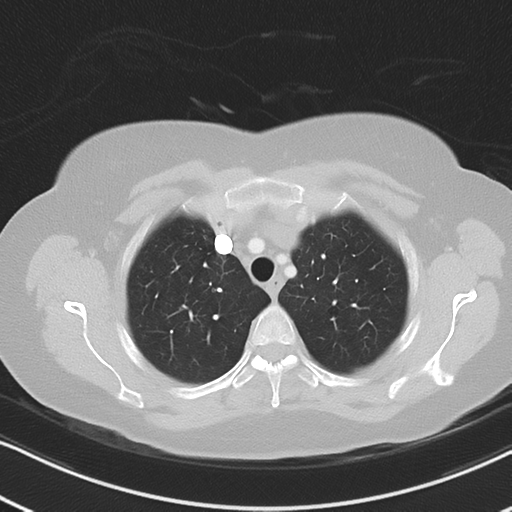 Chronic pulmonary embolus (Radiopaedia 39129-41341 Axial lung window 15).png