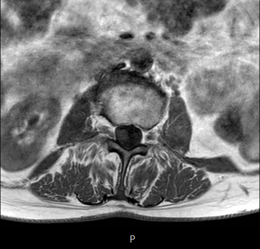 File:Chronic spinal hematoma with cauda equina syndrome (Radiopaedia 75745-87090 Axial T1 12).png