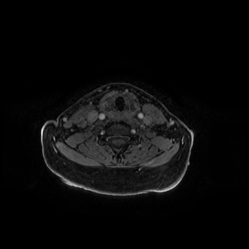 Chronic submandibular sialadenitis (Radiopaedia 61852-69885 Axial T1 C+ fat sat 18).jpg