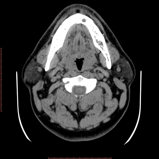 Chronic submandibular sialolithiasis (Radiopaedia 69817-79814 Axial non-contrast 90).jpg