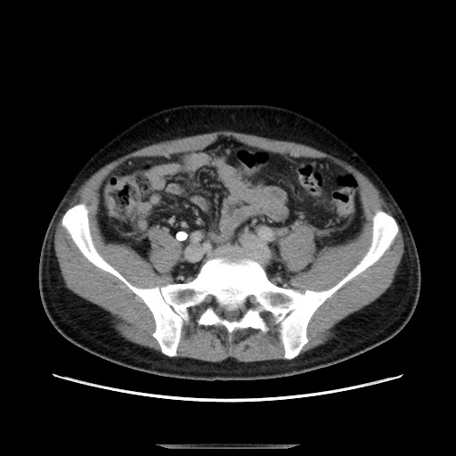 File:Chronic ureteropelvic junction obstruction (Radiopaedia 78365-90996 Axial 38).jpg