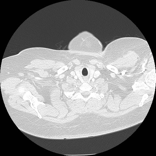 Cicatrisation collapse (Radiopaedia 17405-17089 lung window 5).jpg