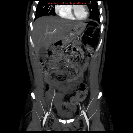 File:Circumaortic left renal vein (Radiopaedia 9069-9792 B 3).jpg