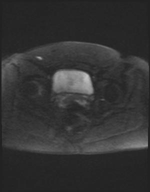 Class II Mullerian duct anomaly- unicornuate uterus with rudimentary horn and non-communicating cavity (Radiopaedia 39441-41755 Axial DWI 52).jpg