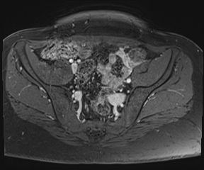 File:Class II Mullerian duct anomaly- unicornuate uterus with rudimentary horn and non-communicating cavity (Radiopaedia 39441-41755 Axial T1 fat sat 30).jpg