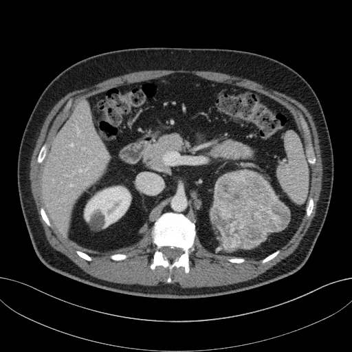 File:Clear cell renal cell carcinoma (Radiopaedia 61449-69393 E 22).jpg