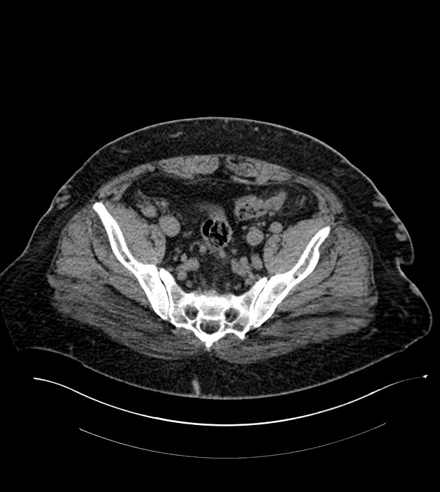 Closed-loop small bowel obstruction-internal hernia (Radiopaedia 78439-91096 Axial non-contrast 127).jpg