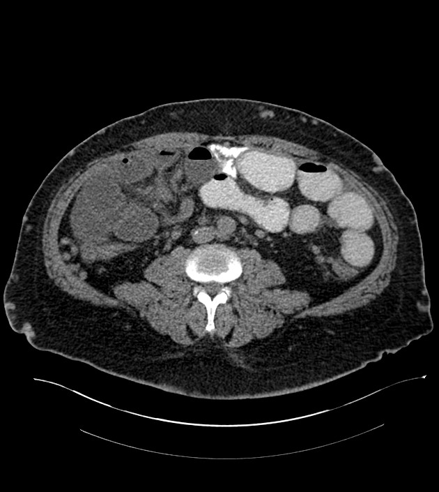 Closed-loop small bowel obstruction-internal hernia (Radiopaedia 78439-91096 Axial non-contrast 89).jpg