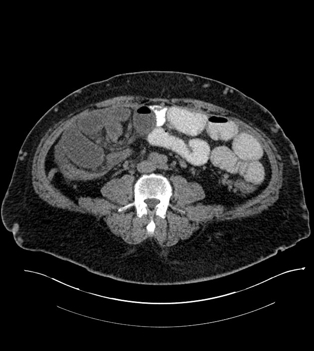 Closed-loop small bowel obstruction-internal hernia (Radiopaedia 78439-91096 Axial non-contrast 93).jpg