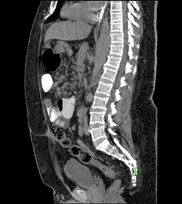 Closed-loop small bowel obstruction-internal hernia (Radiopaedia 78439-91096 C 75).jpg