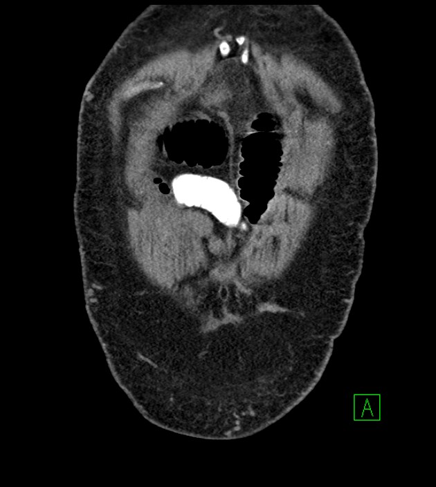 Closed-loop small bowel obstruction-internal hernia (Radiopaedia 78439-91096 Coronal non-contrast 18).jpg