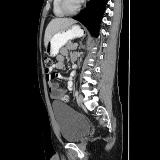 File:Closed-loop small bowel obstruction (Radiopaedia 73713-84509 B 99).jpg