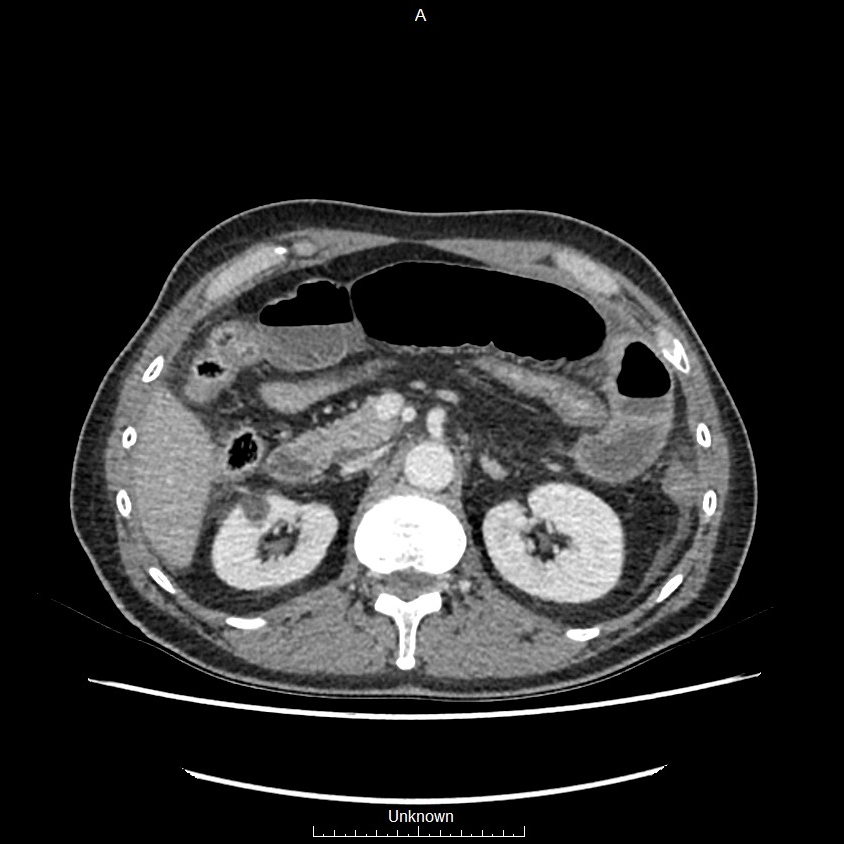 Closed loop bowel obstruction and ischemia (Radiopaedia 86959-103180 A 23).jpg