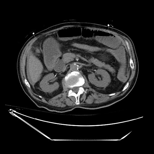 Closed loop obstruction due to adhesive band, resulting in small bowel ischemia and resection (Radiopaedia 83835-99023 Axial non-contrast 59).jpg