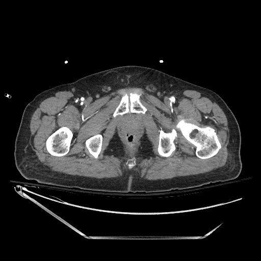 File:Closed loop obstruction due to adhesive band, resulting in small bowel ischemia and resection (Radiopaedia 83835-99023 B 158).jpg